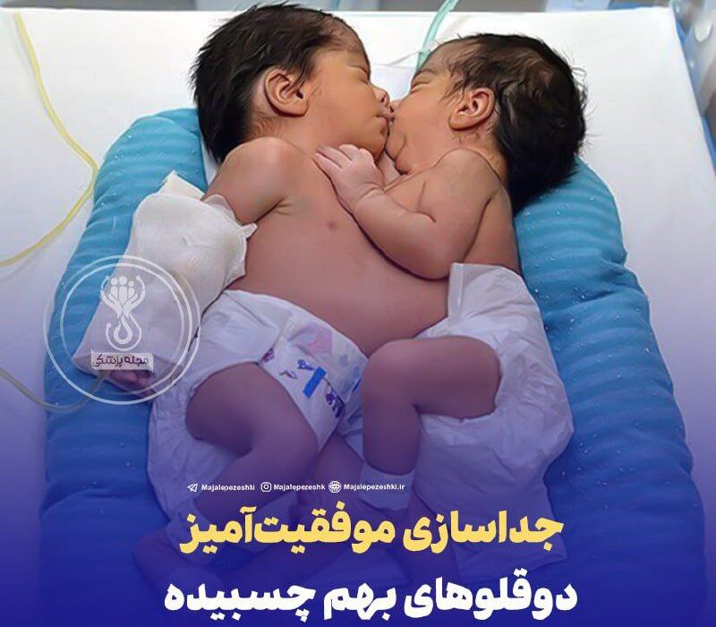 جداسازی مو‌فقیت‌آمیز دوقلو‌های بهم چسبیده