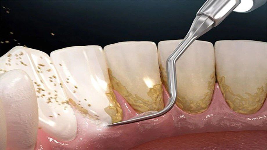 جرم گیری هیچ تاثیر منفی بر مینا و ریشهٔ دندان ها ندارد