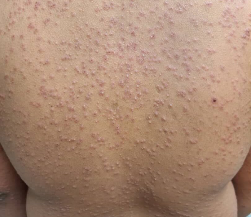 ماجرای این عکس ها چه بود؟/ آبله میمونی یا خیر؟
